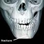 Mandible Fracture profile picture